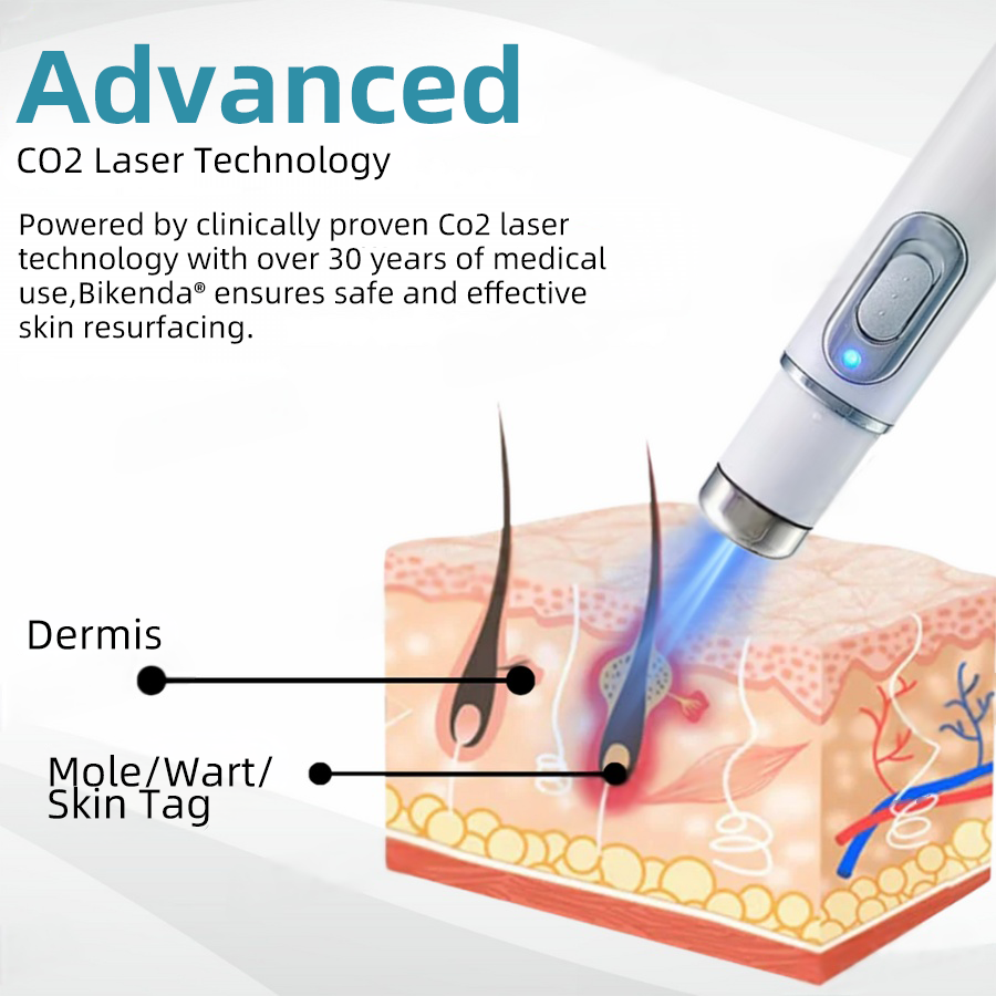 Laatste Dag 50% Korting!🔥I DermaZap™ – Laserpen tegen Wratten & Moedervlekken