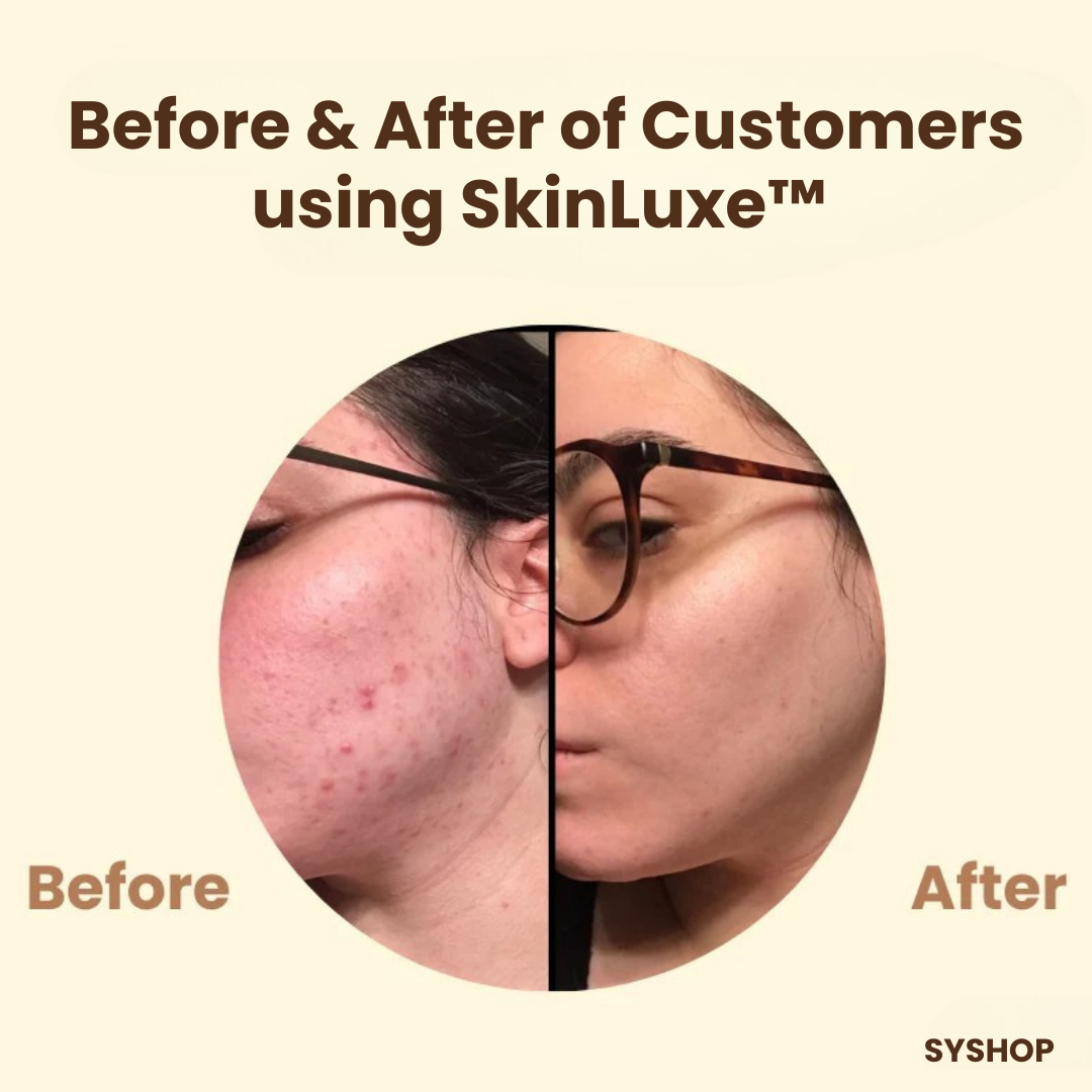 Laatste Dag 50% Korting!🔥I SkinLuxe™ - Zwarte Thee Gezichtsmasker