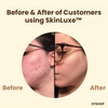Laatste Dag 50% Korting!🔥I SkinLuxe™ - Zwarte Thee Gezichtsmasker