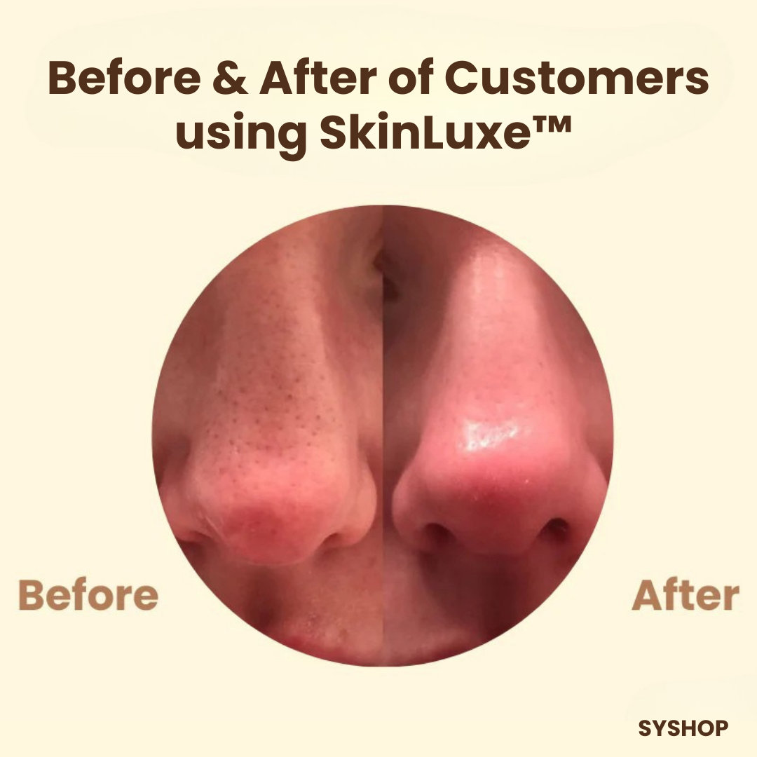 Laatste Dag 50% Korting!🔥I SkinLuxe™ - Zwarte Thee Gezichtsmasker