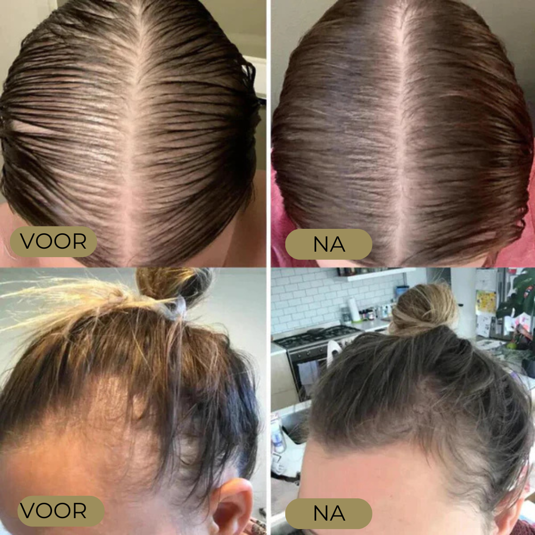 Laatste Dag 50% Korting!🔥I Folivive™ - Natuurlijke olie voor haargroei